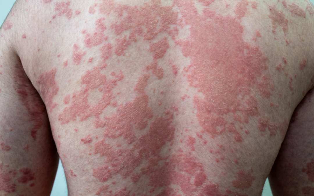 Medical Treatment For Psoriatic Arthritis