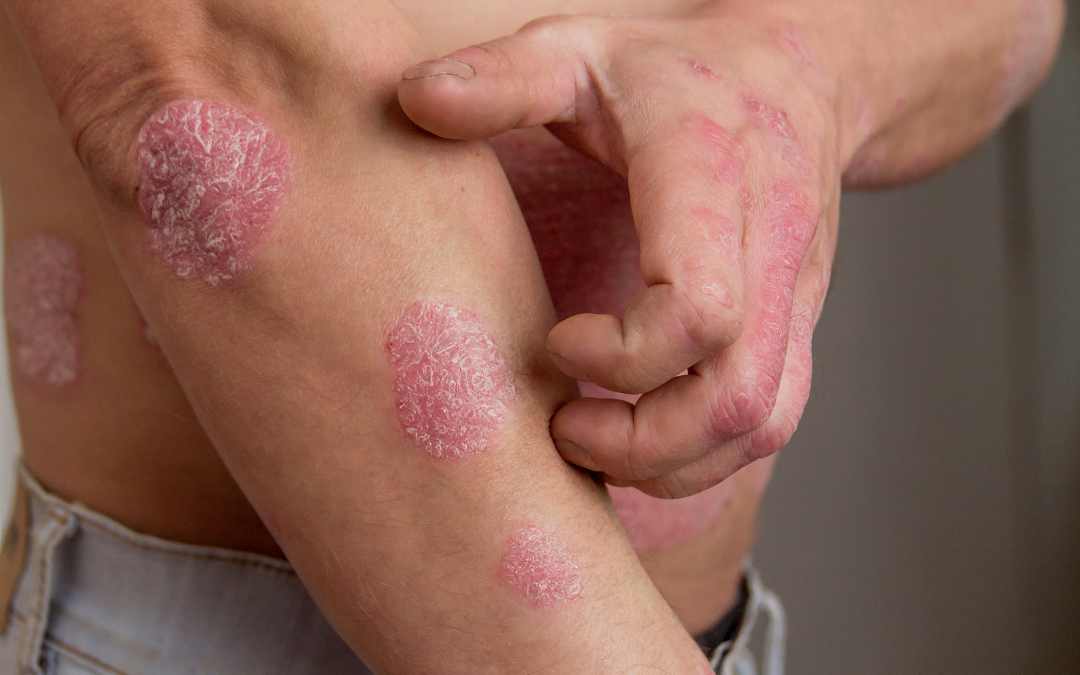 Stress Can Make Your Psoriasis Worse