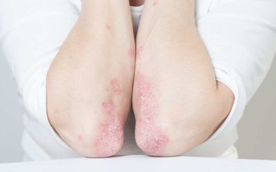 Natural Treatments For Psoriasis