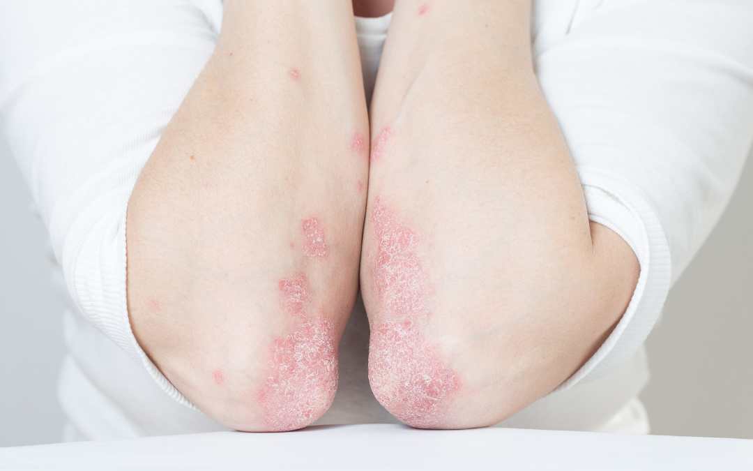 Natural Treatments For Psoriasis