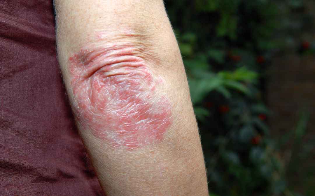Psoriatic Arthritis