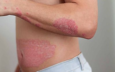 What Causes Psoriasis?