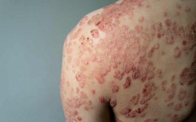 What Is Psoriasis?